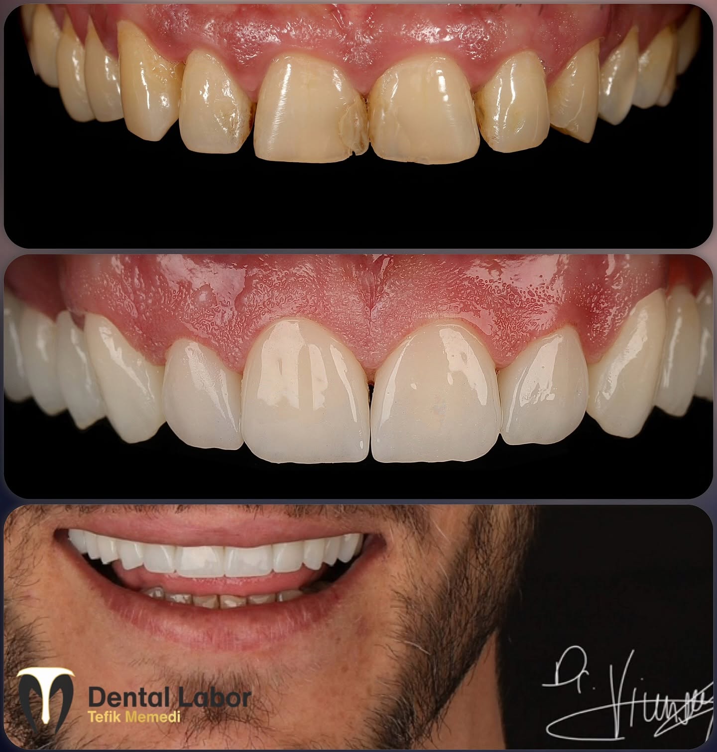 Veneers