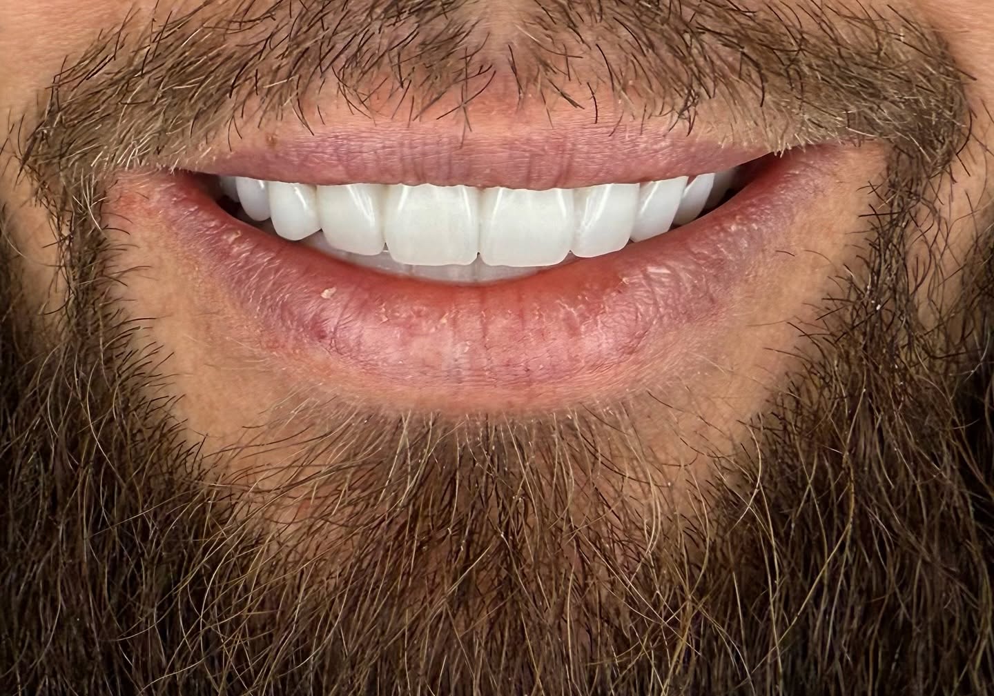 Zirconium Crowns